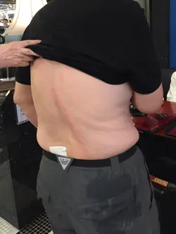 新蒲岗Mikiki 分店经理把一碗滚烫的面豉汤洒在本人父亲的背上，弄得全身湿透及背部红肿